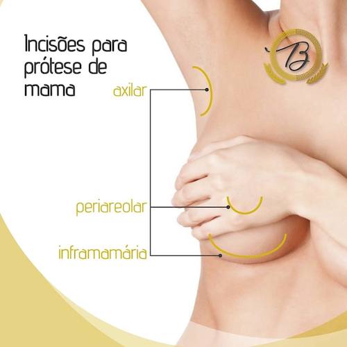Quais os tipos de cicatrizes para colocação de Prótese de Mama